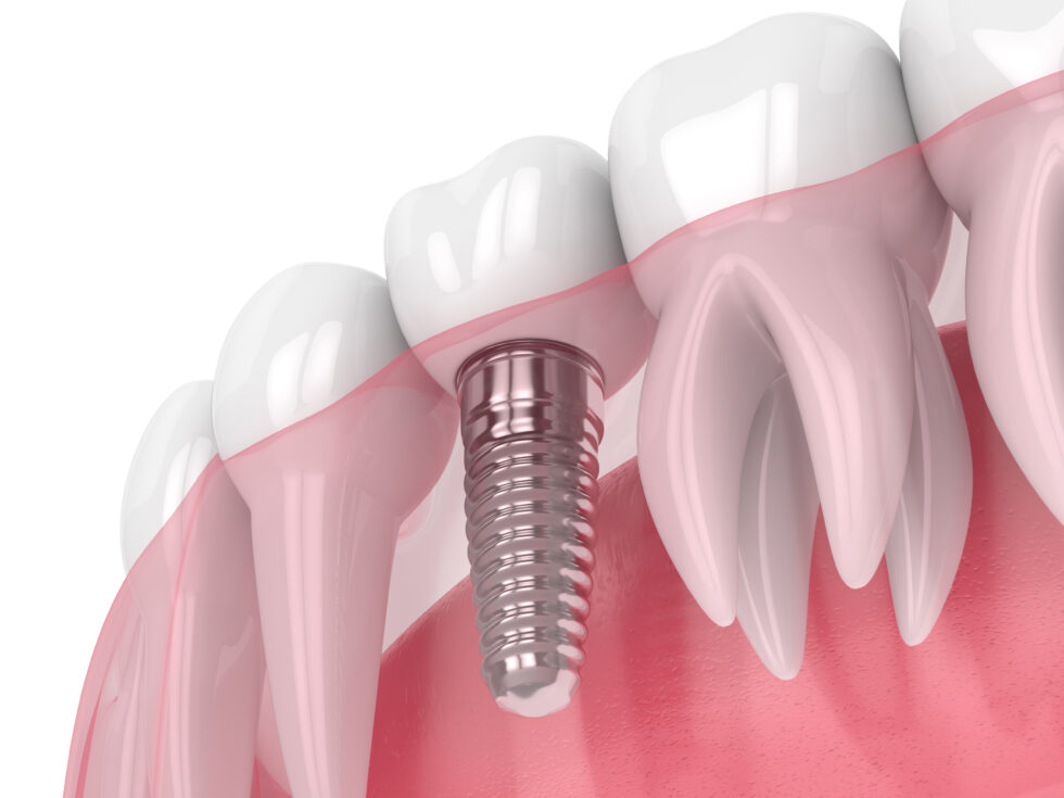 Dental Implants - Dentist Statesboro GA | Dr. McGibony & Associates